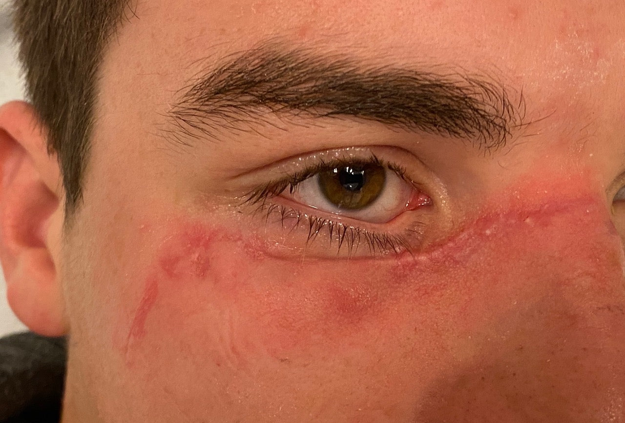 Vóór Scarmask